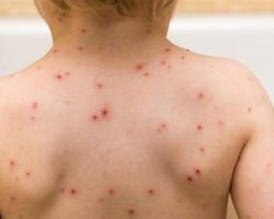 Зголемен бројот на заболени деца од варичела во Куманово